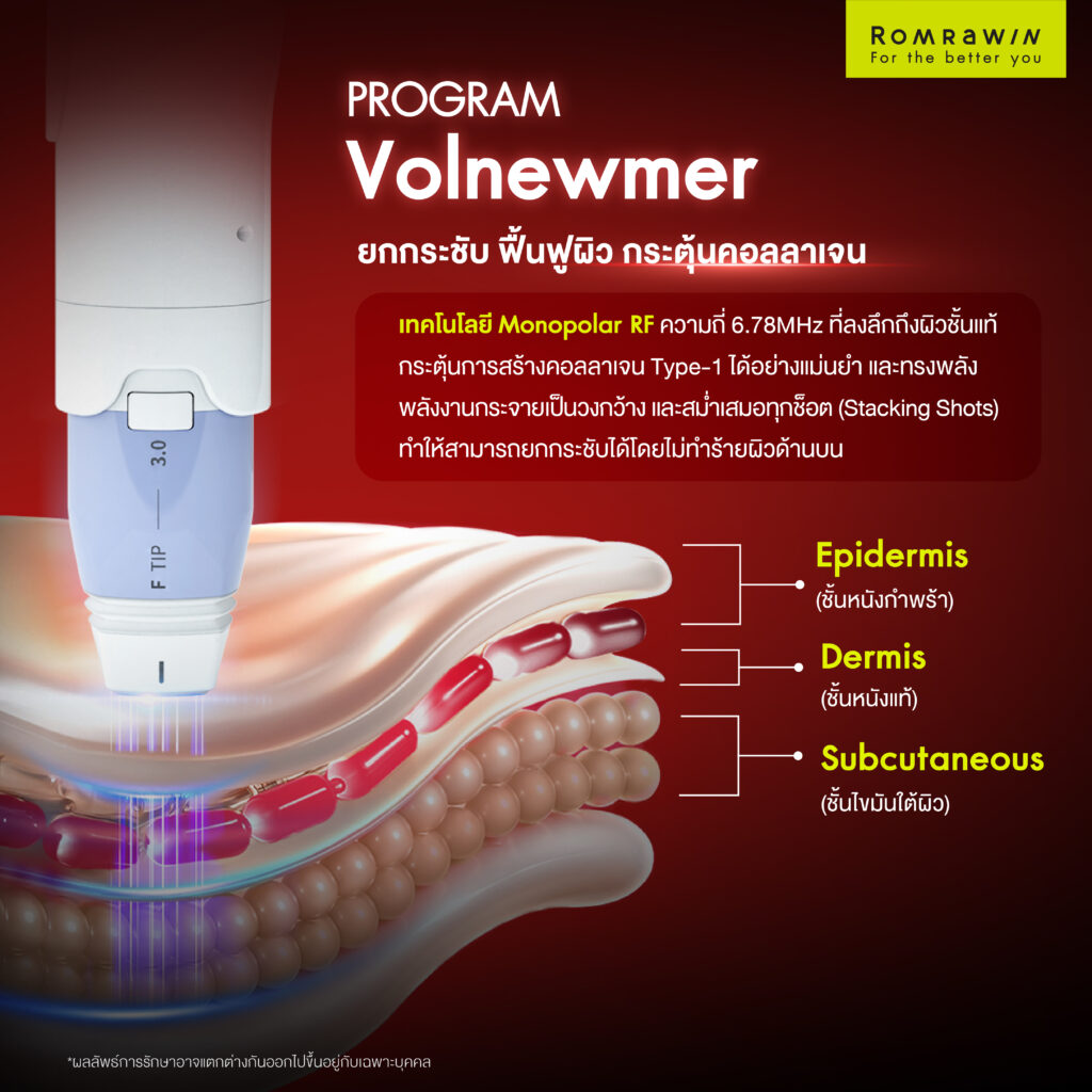 VOLNEWMER คืออะไร