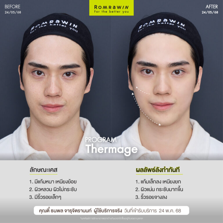 BF AT Thermage ตี๋ 01 0