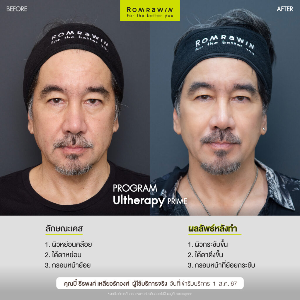 คุณบี๋ ธีรพงศ์ขอเปิดโอกาสดูแลตัวเองอีกครัง ด้วย Ultherapy PRIME  2 คุณบี๋ขอเปิดโอกาสดูแลตัวเองอีกครัง ด้วย Ultherapy PRIME