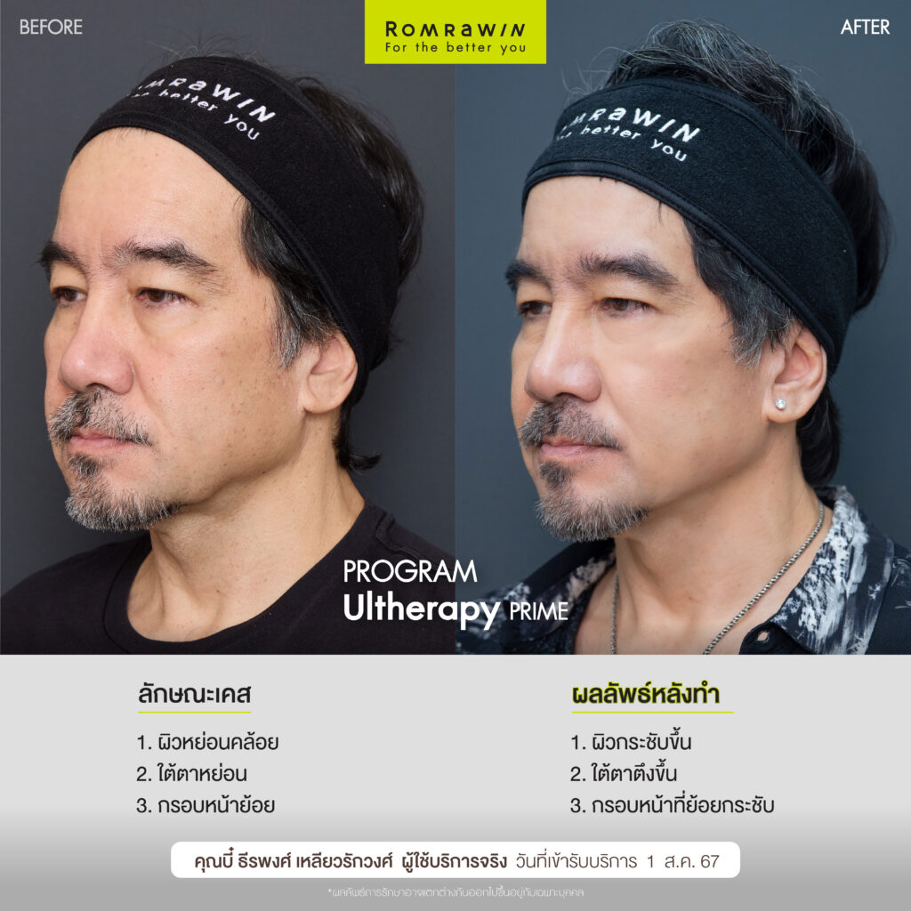 คุณบี๋ ธีรพงศ์ขอเปิดโอกาสดูแลตัวเองอีกครัง ด้วย Ultherapy PRIME  4 คุณบี๋ขอเปิดโอกาสดูแลตัวเองอีกครัง ด้วย Ultherapy PRIME