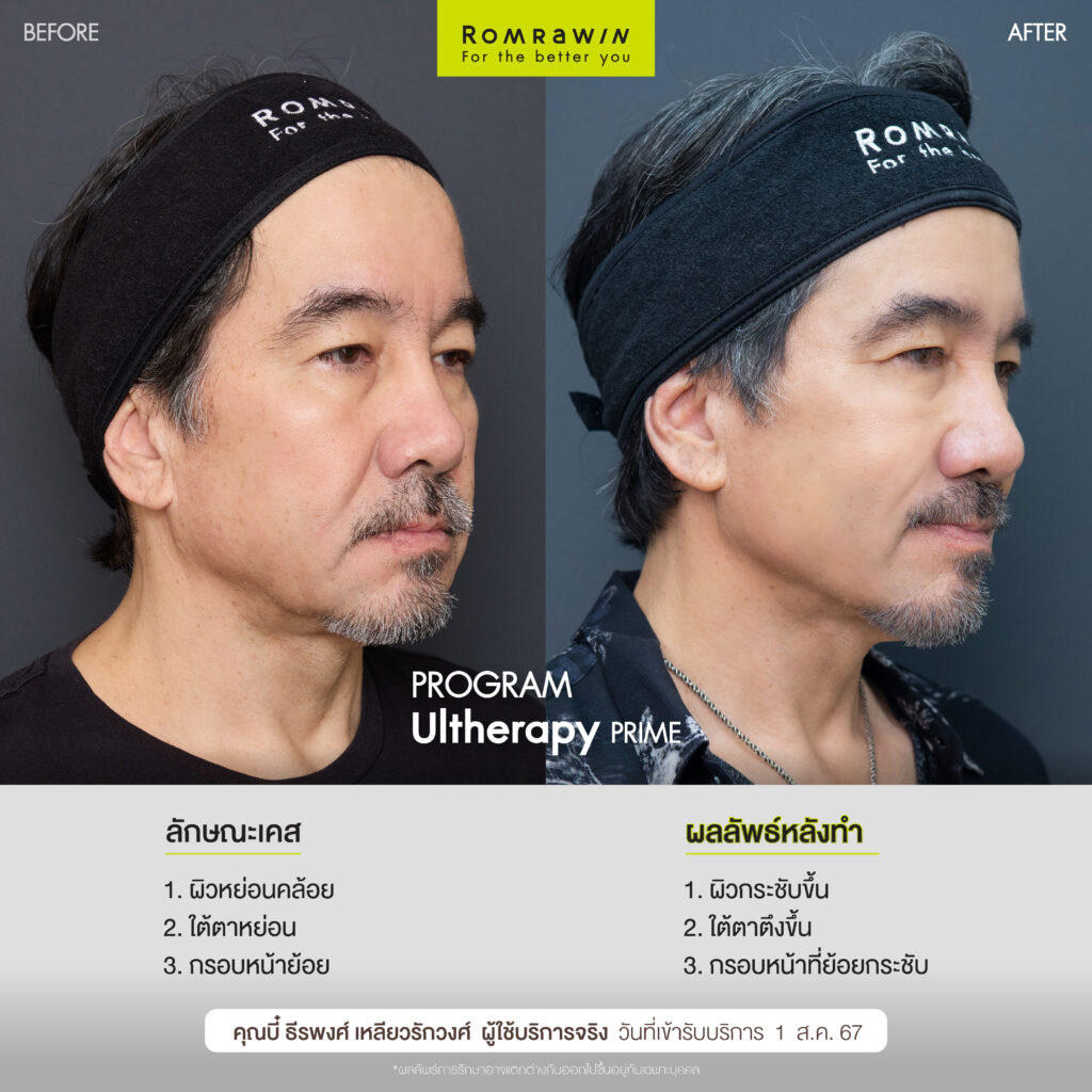 คุณบี๋ ธีรพงศ์ขอเปิดโอกาสดูแลตัวเองอีกครัง ด้วย Ultherapy PRIME  3 คุณบี๋ขอเปิดโอกาสดูแลตัวเองอีกครัง ด้วย Ultherapy PRIME