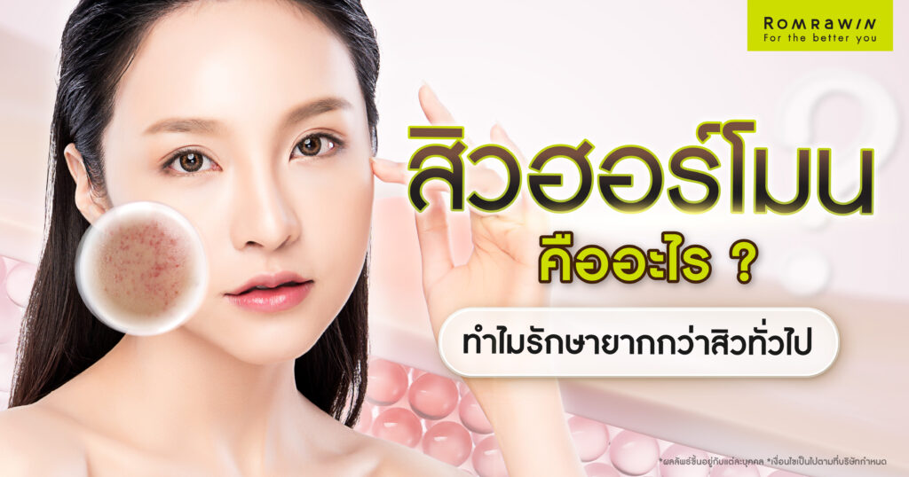 สิวฮอร์โมนคืออะไร ? ทำไมรักษายากกว่าสิวทั่วไป 1 สิวฮอร์โมน