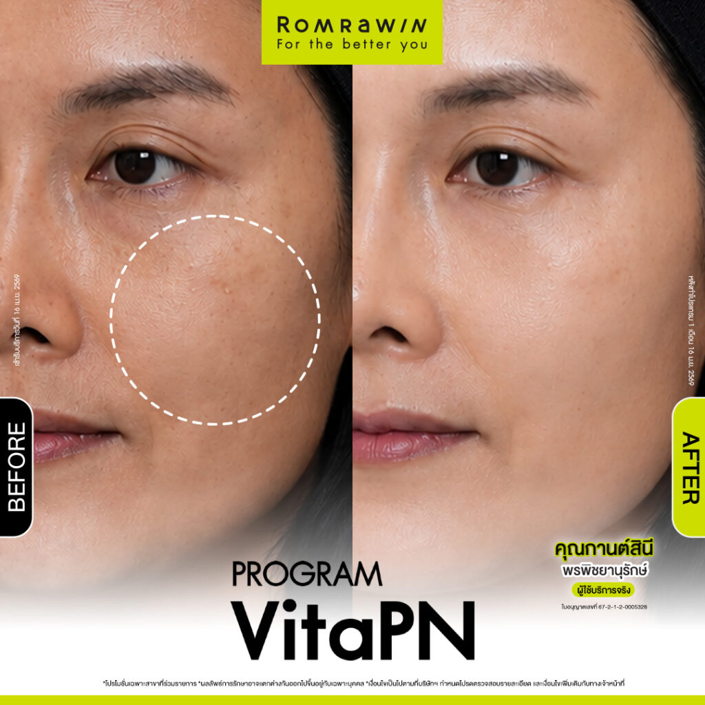 VITARAN I โปรแกรมฟื้นฟูผิวแข็งแรงด้วย Polynucleotide 22 ผลลัพธ์ขึ้นอยู่กับแต่ละบุคคล