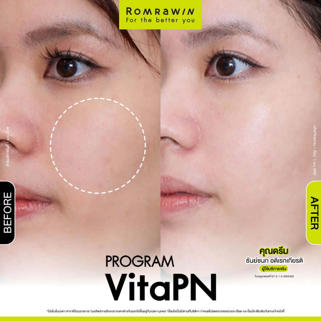 VITARAN I โปรแกรมฟื้นฟูผิวแข็งแรงด้วย Polynucleotide 16 ผลลัพธ์ขึ้นอยู่กับแต่ละบุคคล