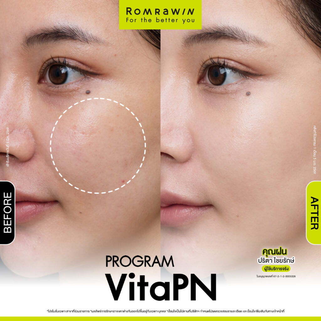 VITARAN I โปรแกรมฟื้นฟูผิวแข็งแรงด้วย Polynucleotide 20 ผลลัพธ์ขึ้นอยู่กับแต่ละบุคคล