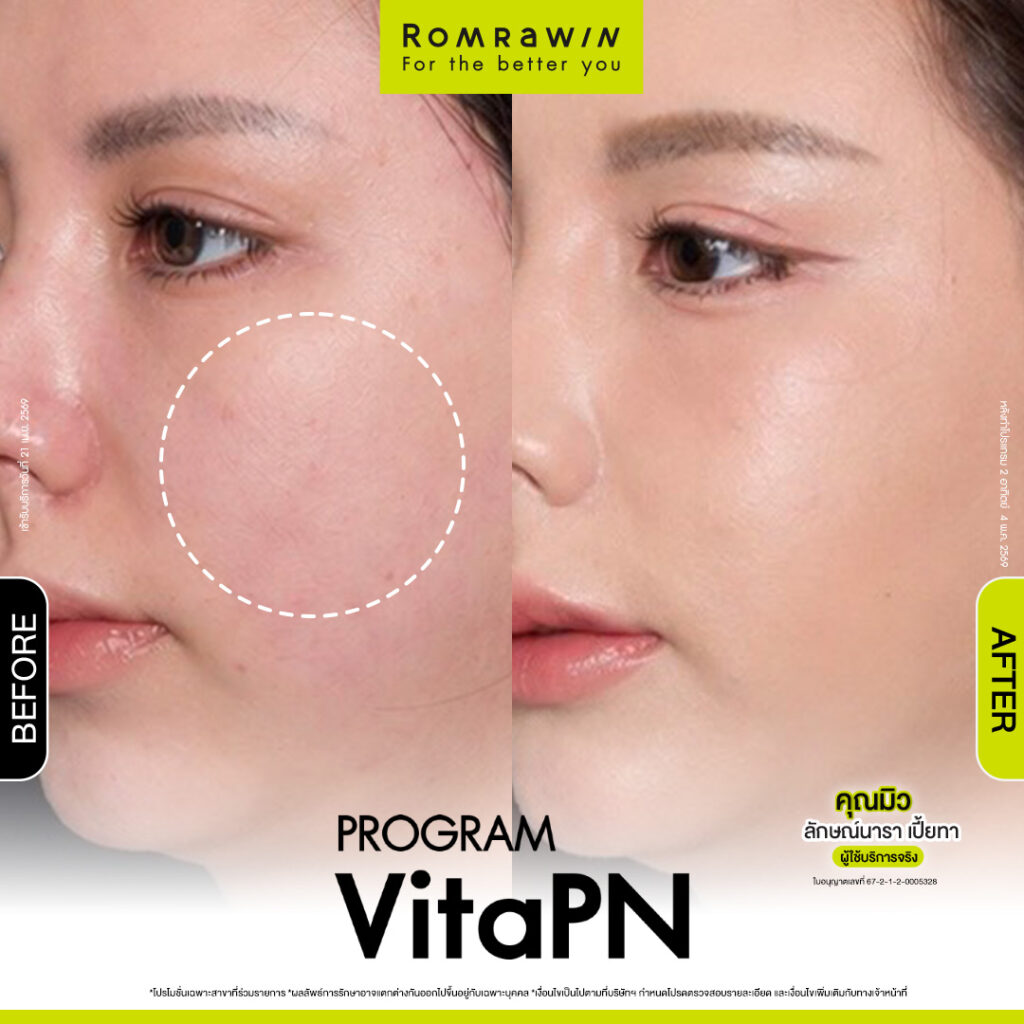VITARAN I โปรแกรมฟื้นฟูผิวแข็งแรงด้วย Polynucleotide 3 ผลลัพธ์ขึ้นอยู่กับแต่ละบุคคล
