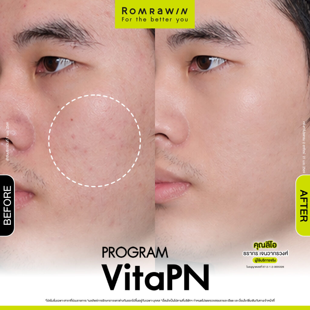 VITARAN I โปรแกรมฟื้นฟูผิวแข็งแรงด้วย Polynucleotide 21 ผลลัพธ์ขึ้นอยู่กับแต่ละบุคคล