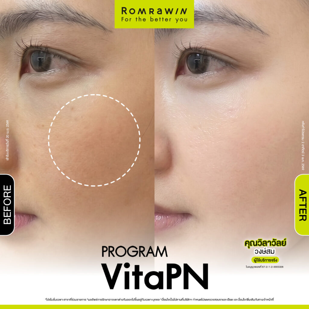 VITARAN I โปรแกรมฟื้นฟูผิวแข็งแรงด้วย Polynucleotide 23 ผลลัพธ์ขึ้นอยู่กับแต่ละบุคคล