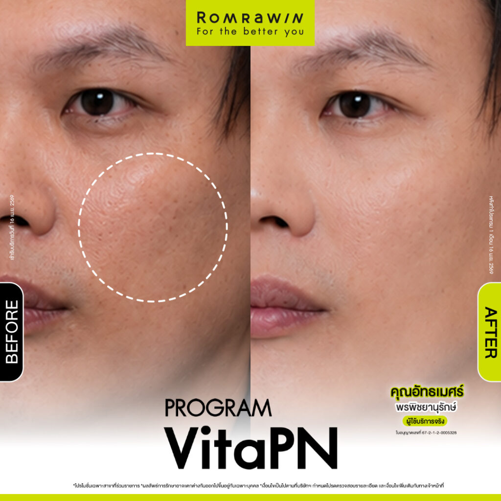 VITARAN I โปรแกรมฟื้นฟูผิวแข็งแรงด้วย Polynucleotide 13 ผลลัพธ์ขึ้นอยู่กับแต่ละบุคคล