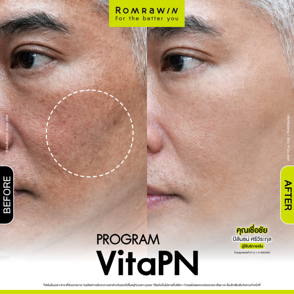 VITARAN I โปรแกรมฟื้นฟูผิวแข็งแรงด้วย Polynucleotide 6 ผลลัพธ์ขึ้นอยู่กับแต่ละบุคคล