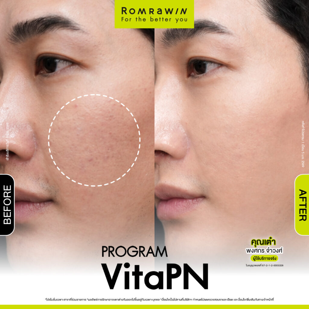 VITARAN I โปรแกรมฟื้นฟูผิวแข็งแรงด้วย Polynucleotide 17 ผลลัพธ์ขึ้นอยู่กับแต่ละบุคคล