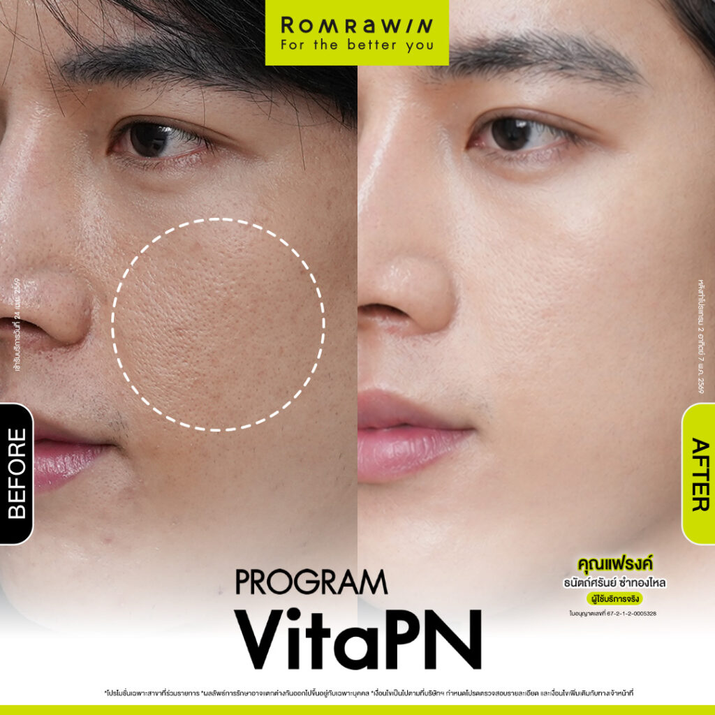 VITARAN I โปรแกรมฟื้นฟูผิวแข็งแรงด้วย Polynucleotide 5 ผลลัพธ์ขึ้นอยู่กับแต่ละบุคคล