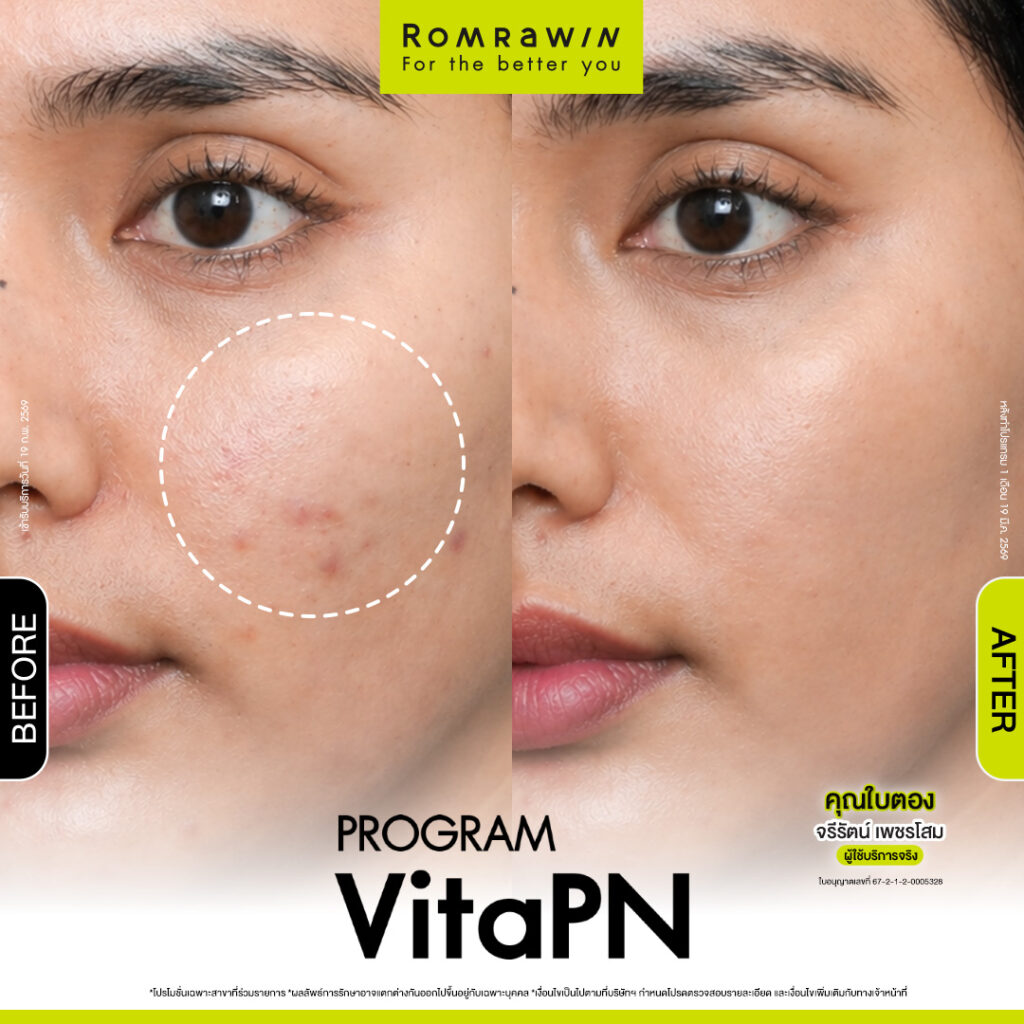 VITARAN I โปรแกรมฟื้นฟูผิวแข็งแรงด้วย Polynucleotide 14 ผลลัพธ์ขึ้นอยู่กับแต่ละบุคคล