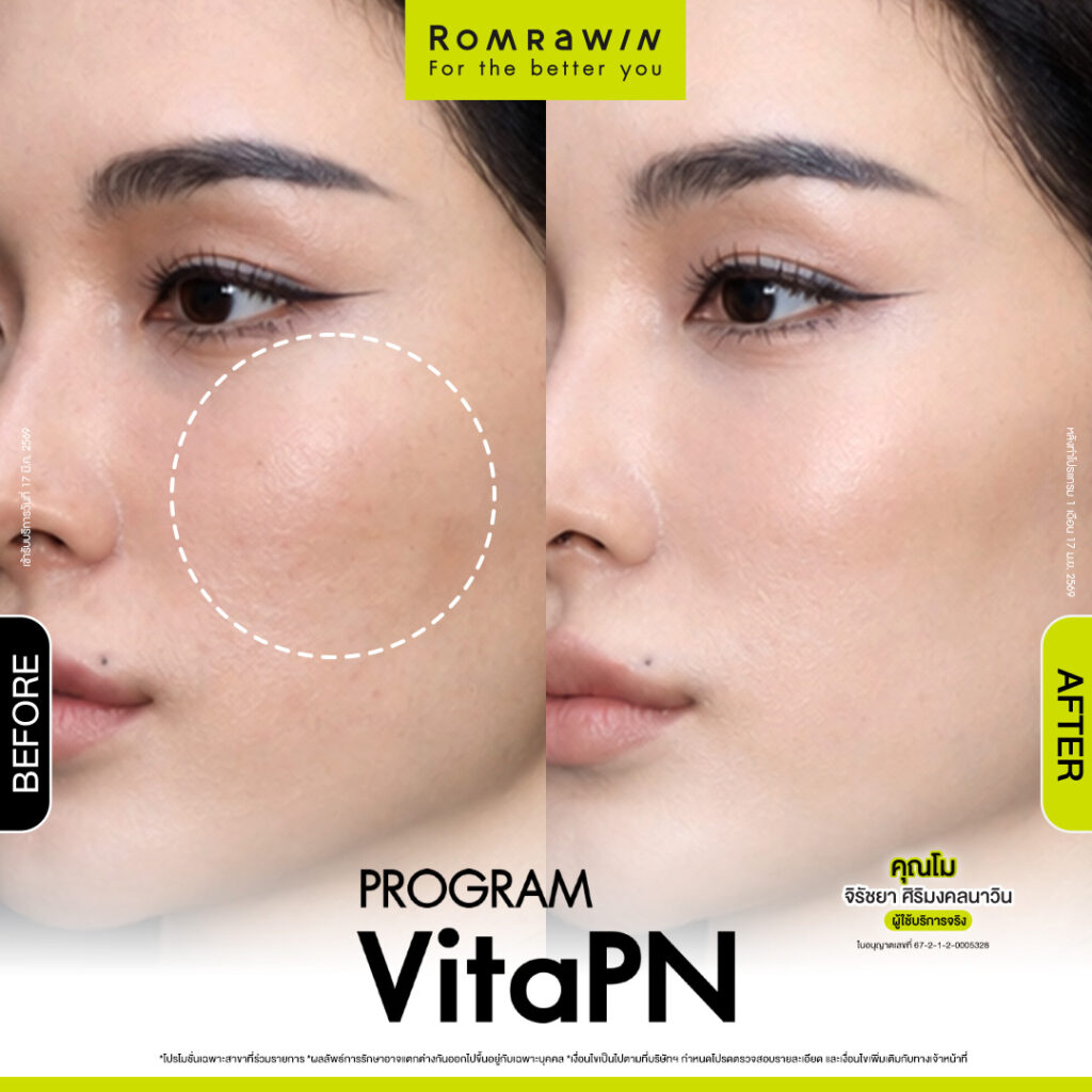 VITARAN I โปรแกรมฟื้นฟูผิวแข็งแรงด้วย Polynucleotide 2 ผลลัพธ์ขึ้นอยู่กับแต่ละบุคคล
