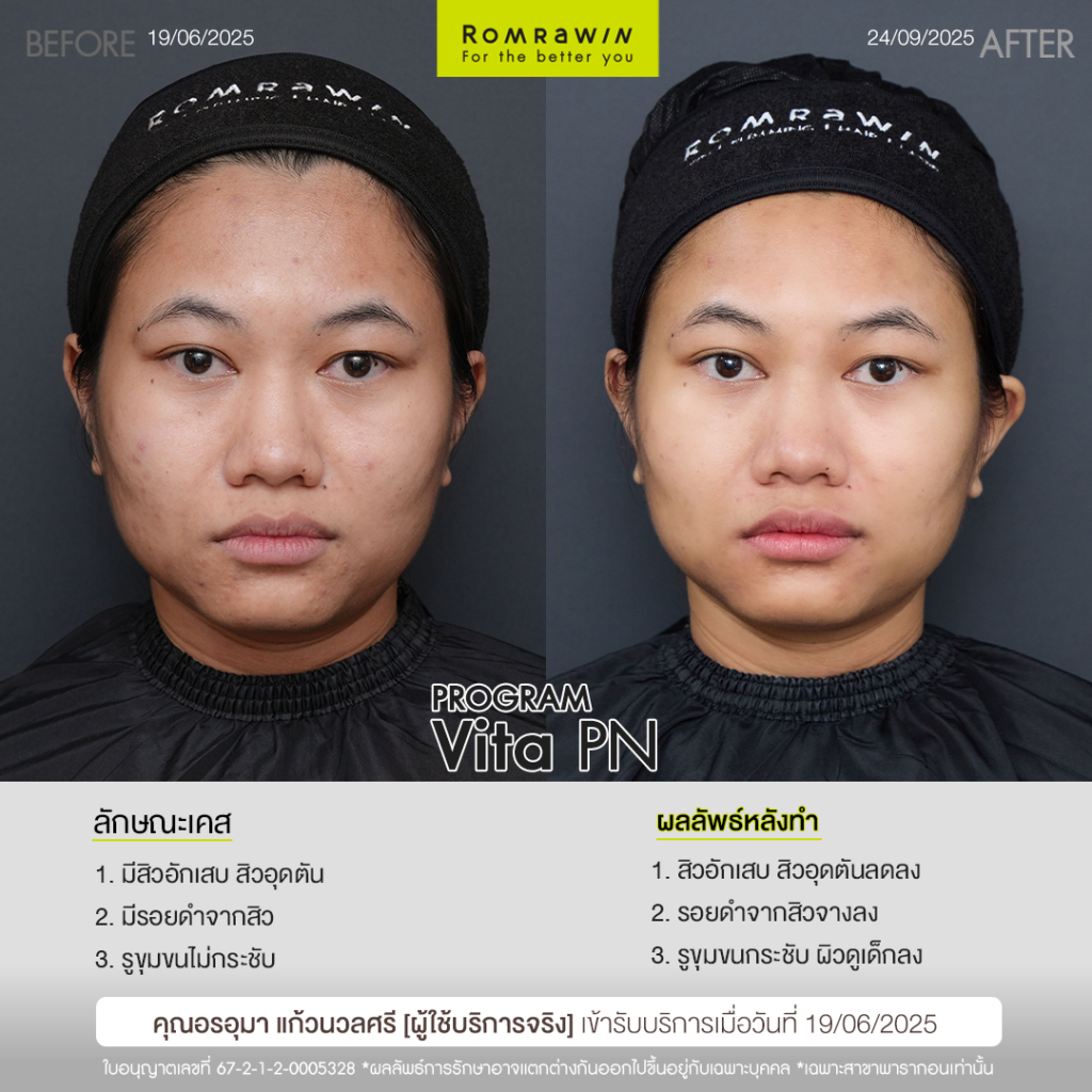 VITARAN I โปรแกรมฟื้นฟูผิวแข็งแรงด้วย Polynucleotide 3 รีวิว Vitaran