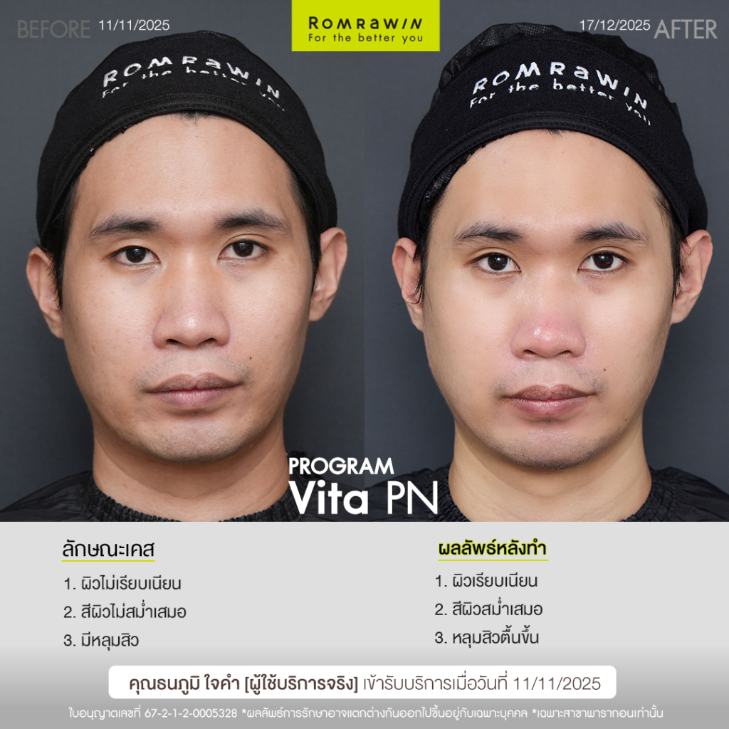 VITARAN I โปรแกรมฟื้นฟูผิวแข็งแรงด้วย Polynucleotide 7 รีวิว Vitaran