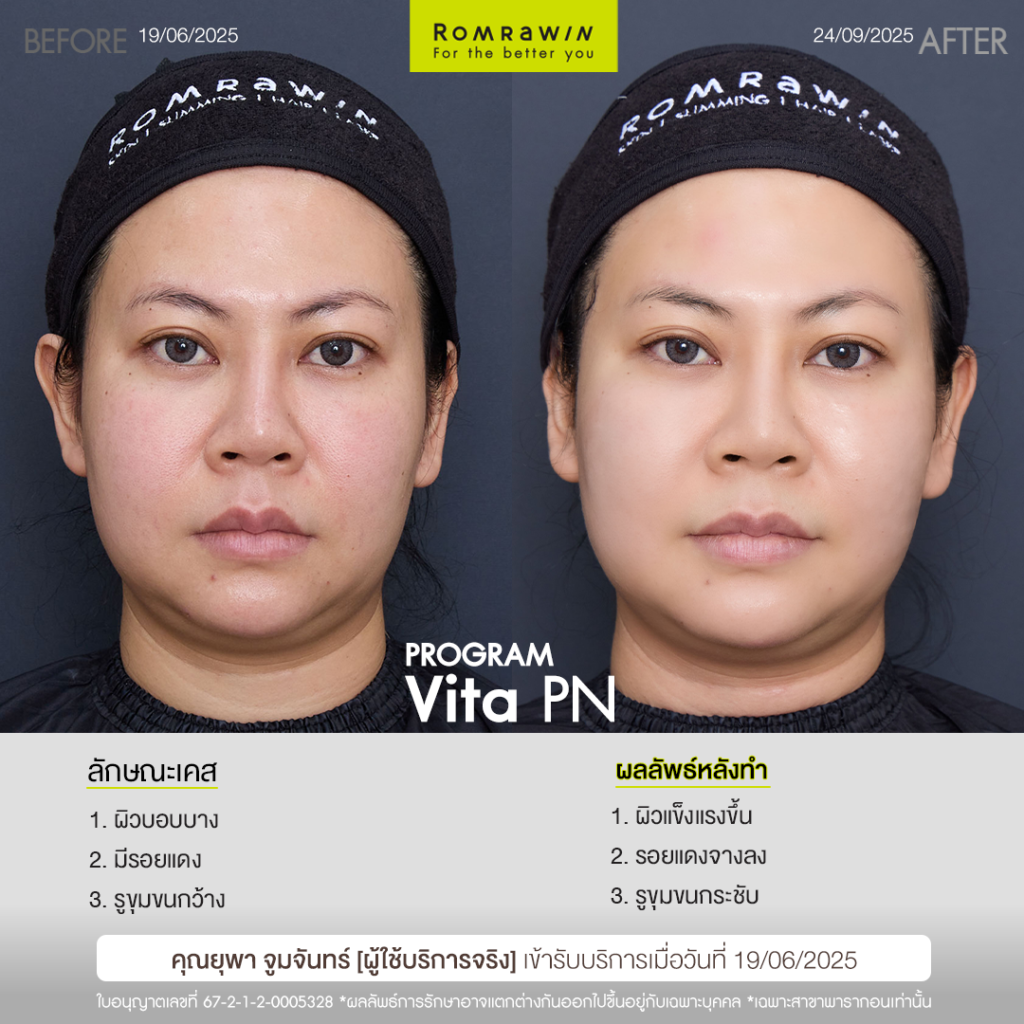 VITARAN I โปรแกรมฟื้นฟูผิวแข็งแรงด้วย Polynucleotide 15 รีวิว Vitaran