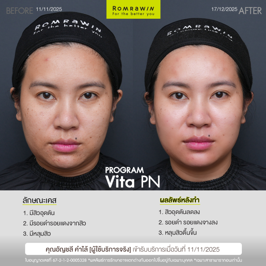 VITARAN I โปรแกรมฟื้นฟูผิวแข็งแรงด้วย Polynucleotide 5 รีวิว Vitaran