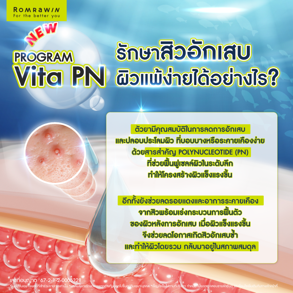 VITARAN I โปรแกรมฟื้นฟูผิวแข็งแรงด้วย Polynucleotide 14 Vitaran I รักษาสิวอักเสบและผิวแพ้ง่ายได้อย่างไร?