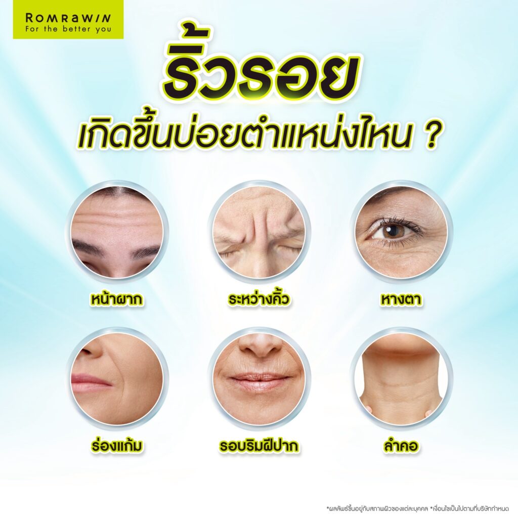 ตำแหน่งที่พบริ้วรอยบ่อย