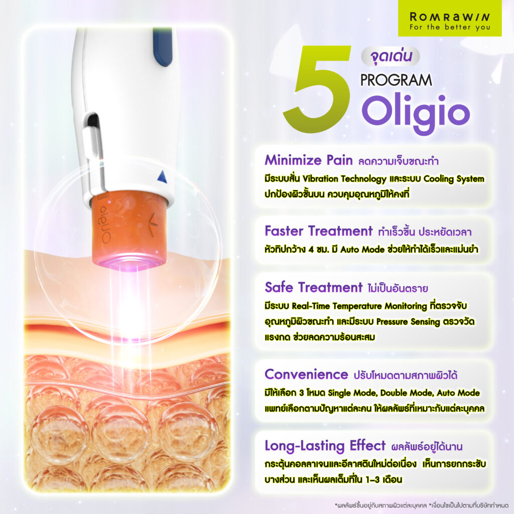 จุดเด่นของเครื่อง Oligio ยกกระชับ ลดเหนียง