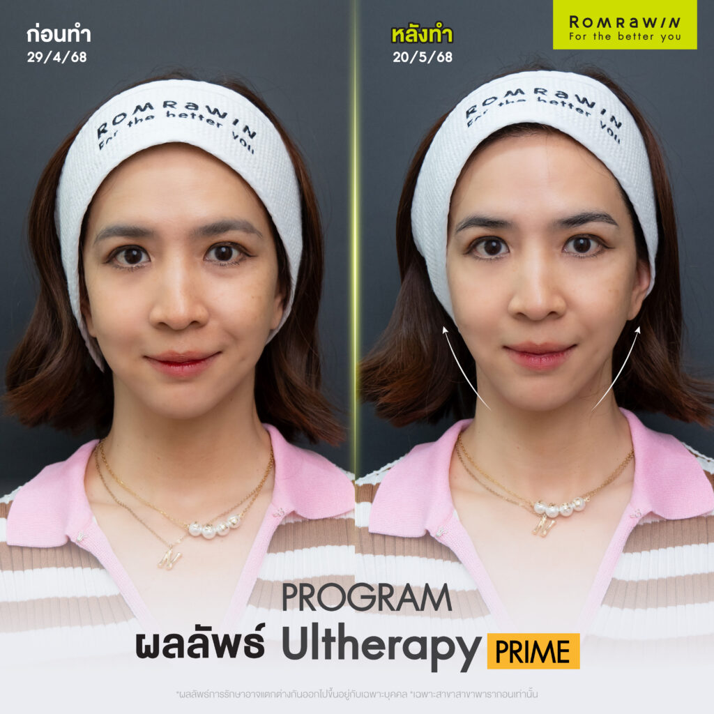 แนน ชลิตา เฟื่องอารมย์ Happy มาก หน้ายกชัด เห็นชัด Ultherapy PRIME ไม่เจ็บอย่างที่คิด 3 แนน ชลิตา เฟื่องอารมย์ Happy มาก หน้ายกชัด เห็นชัด Ultherapy PRIME ไม่เจ็บอย่างที่คิด