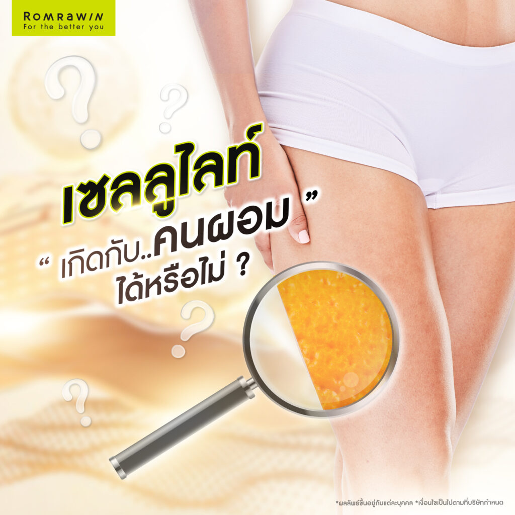 เซลลูไลท์ (Cellulite) เกิดกับคนผอมได้หรือไม่?