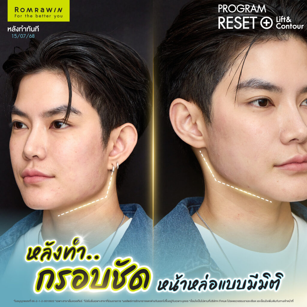 คุณติ๊นา ศุภนาฎ กรอบหน้าไม่ชัด จัดโปรแกรม Reset + Lift & Contour ก็ชัดเลย 