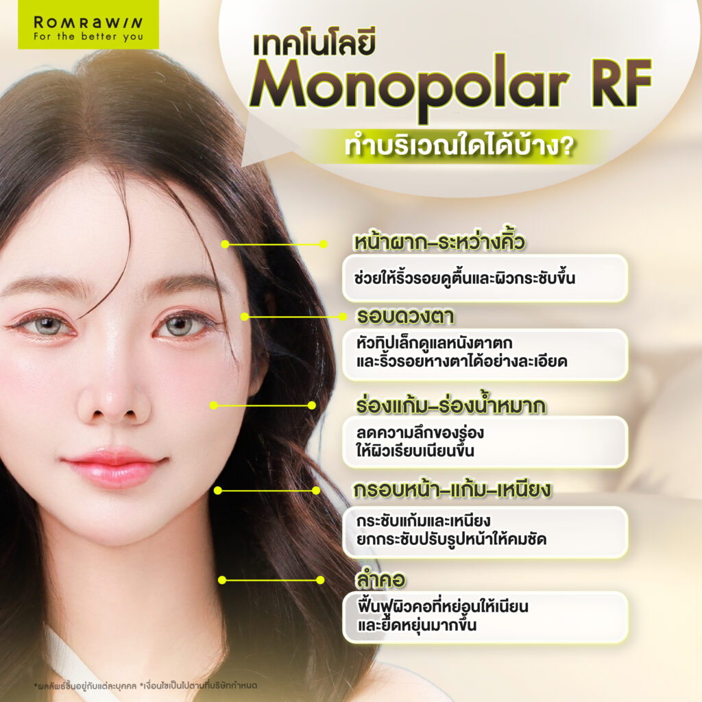 พื้นที่บนใบหน้าที่สามารถใช้เทคโนโลยี Monopolar RF ดูแลได้