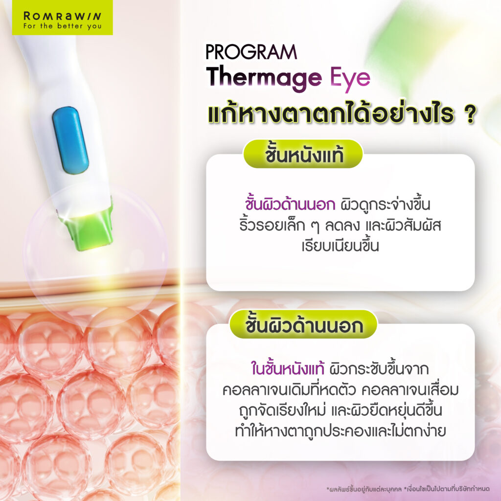 ปัญหาหางตาตกที่มากับวัย Thermage Eye แก้หางตาตก ฟื้นฟูผิวรอบดวงตาได้อย่างไร 2 Thermage Eye แก้หางตาตกได้อย่างไร?