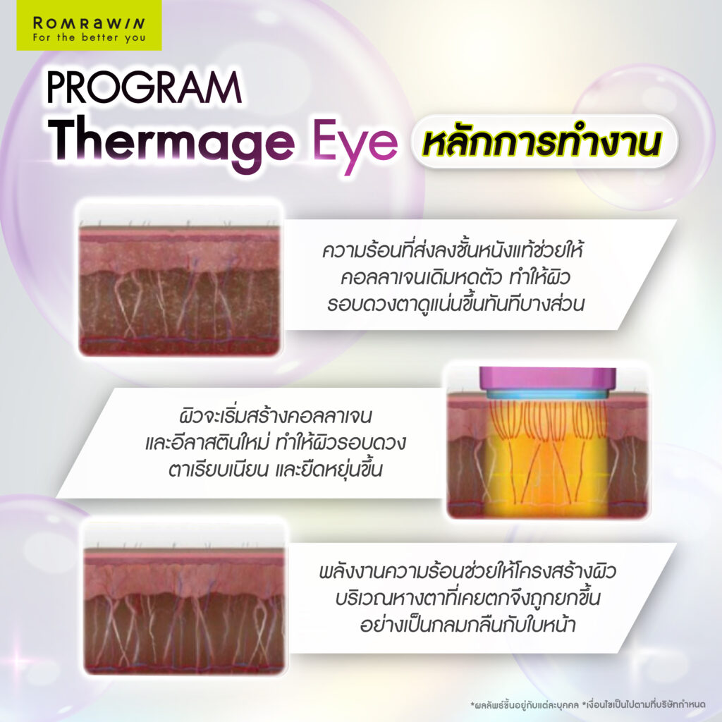 ปัญหาหางตาตกที่มากับวัย Thermage Eye แก้หางตาตก ฟื้นฟูผิวรอบดวงตาได้อย่างไร 4 หลักการทำงานของ Thermage Eye แก้หางตาตก