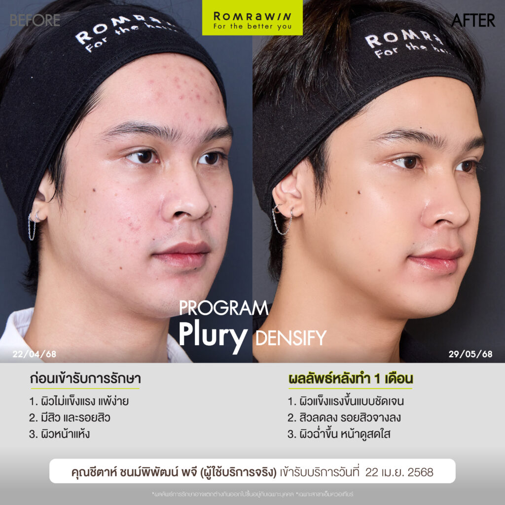 คุณชีตาห์ ชนม์พิพัฒน์ หมดกังวลเรื่องผิวอ่อม บูสต์ผิวฉ่ำด้วยโปรแกรม Plury Densify 5 บูสต์ผิวฉ่ำด้วยโปรแกรม Plury Densify