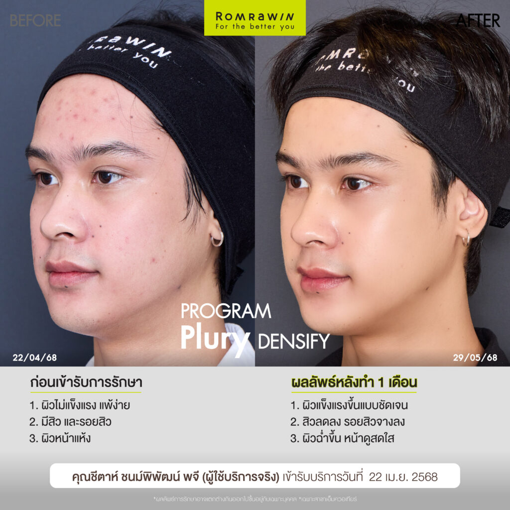 คุณชีตาห์ ชนม์พิพัฒน์ หมดกังวลเรื่องผิวอ่อม บูสต์ผิวฉ่ำด้วยโปรแกรม Plury Densify 4 บูสต์ผิวฉ่ำด้วยโปรแกรม Plury Densify