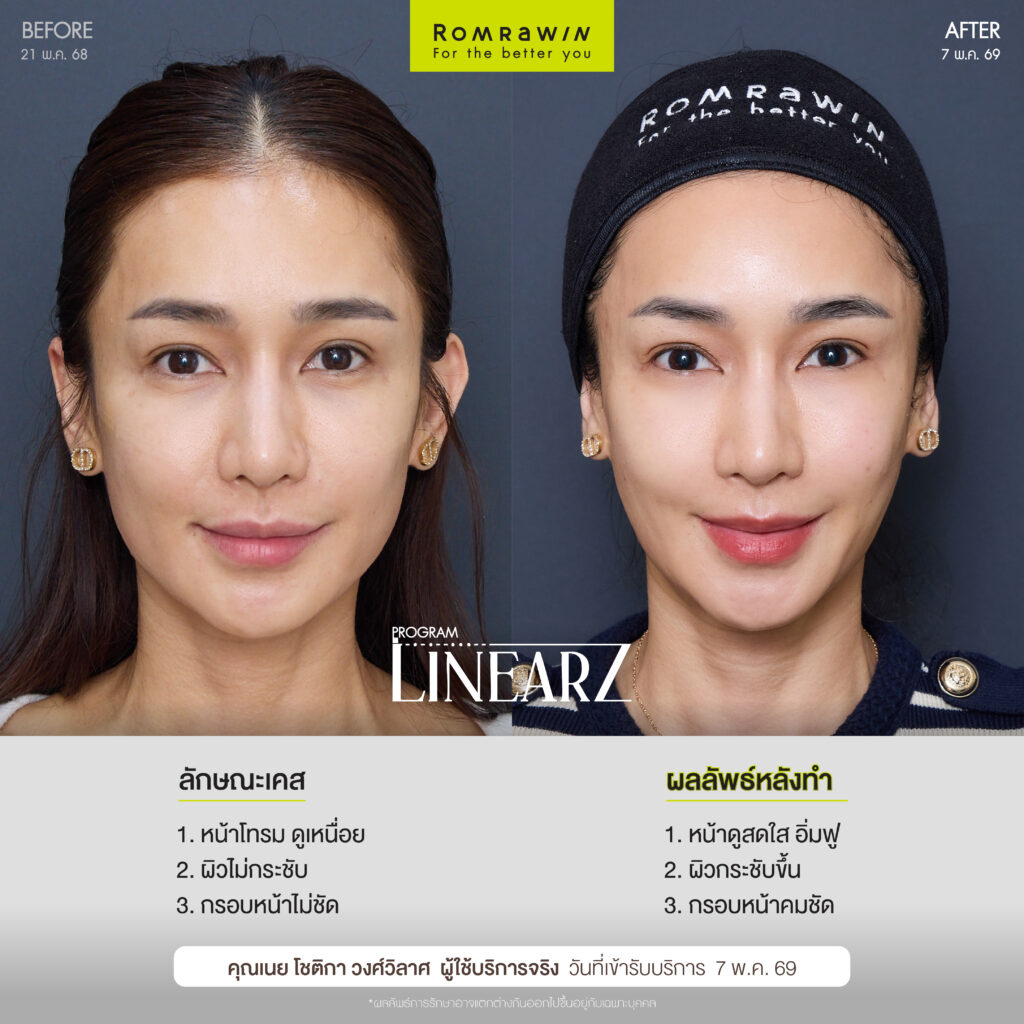 LINEAR Z เทคโนโลยียกกระชับ Custom-designed Lifting กระชับผิวเห็นผลชัด เจ็บน้อย ไม่ต้องพักฟื้น 2 ผลลัพธ์ขึ้นอยู่กับแต่ละบุคคล