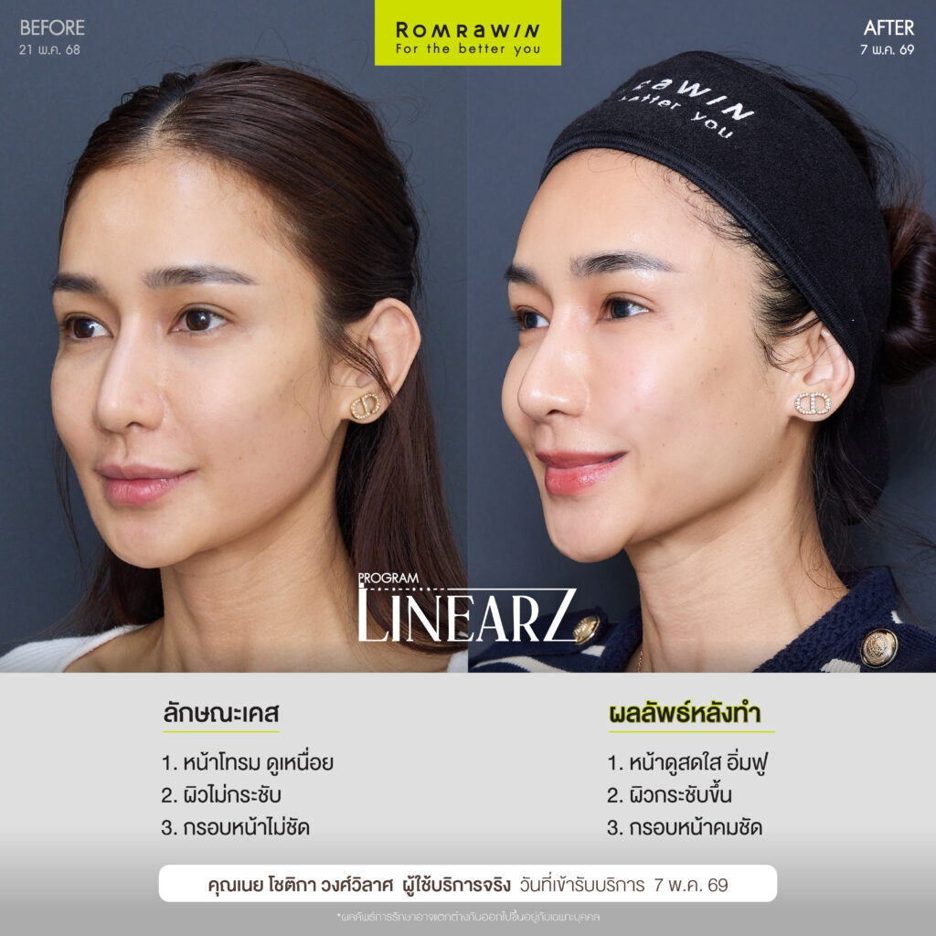 LINEAR Z เทคโนโลยียกกระชับ Custom-designed Lifting กระชับผิวเห็นผลชัด เจ็บน้อย ไม่ต้องพักฟื้น 3 ผลลัพธ์ขึ้นอยู่กับแต่ละบุคคล