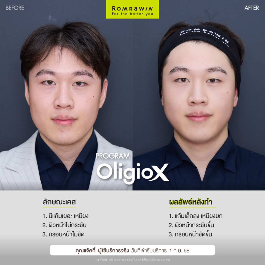 ยกกระชับหน้าพี่แจ้กกี้ด้วยโปรแกรม Oligio X เย็น ยก ยุบนาน
