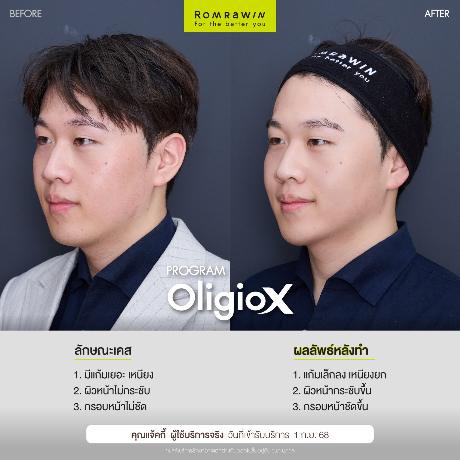 ยกกระชับหน้าพี่แจ้กกี้ด้วยโปรแกรม Oligio X เย็น ยก ยุบนาน