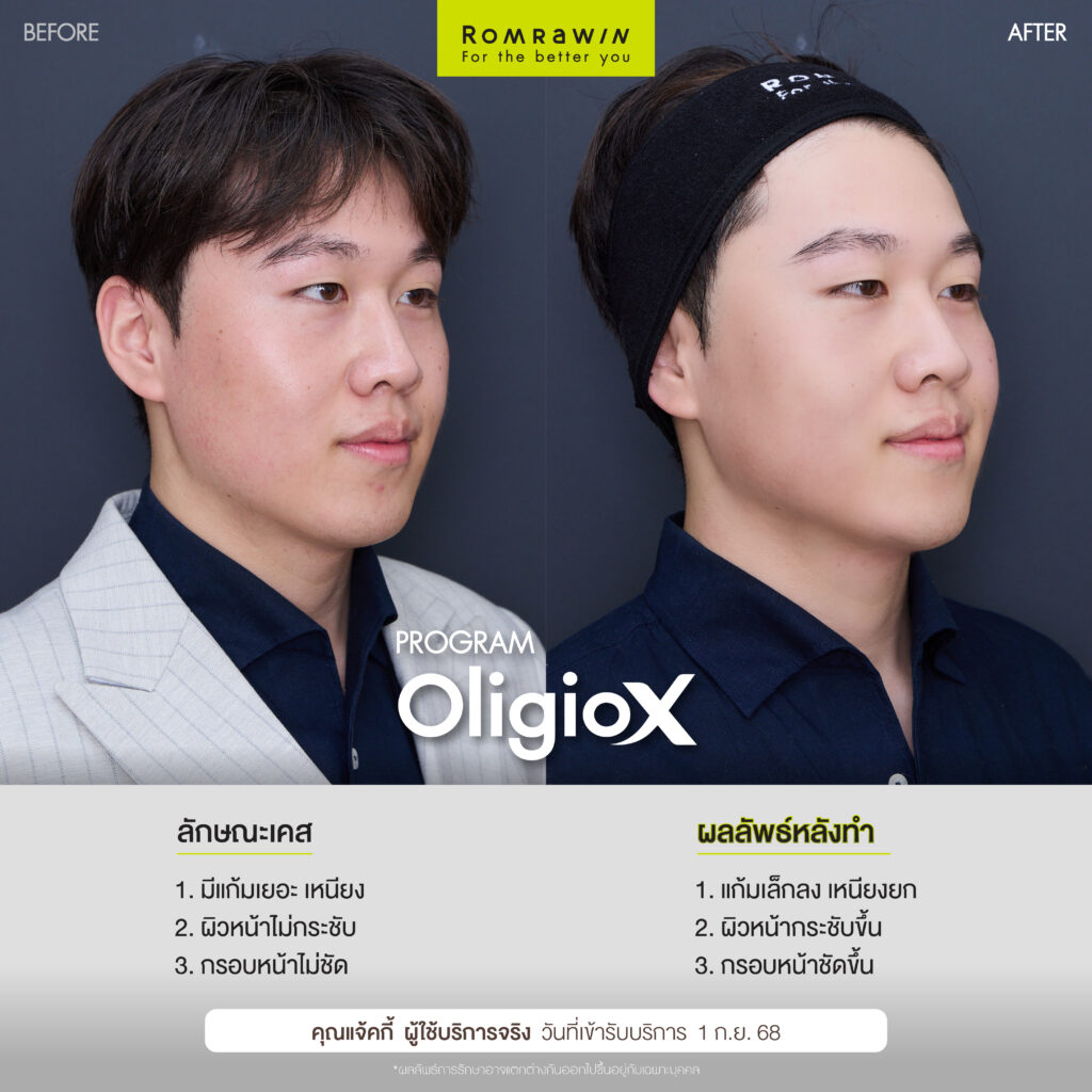 ยกกระชับหน้าพี่แจ้กกี้ด้วยโปรแกรม Oligio X เย็น ยก ยุบนาน