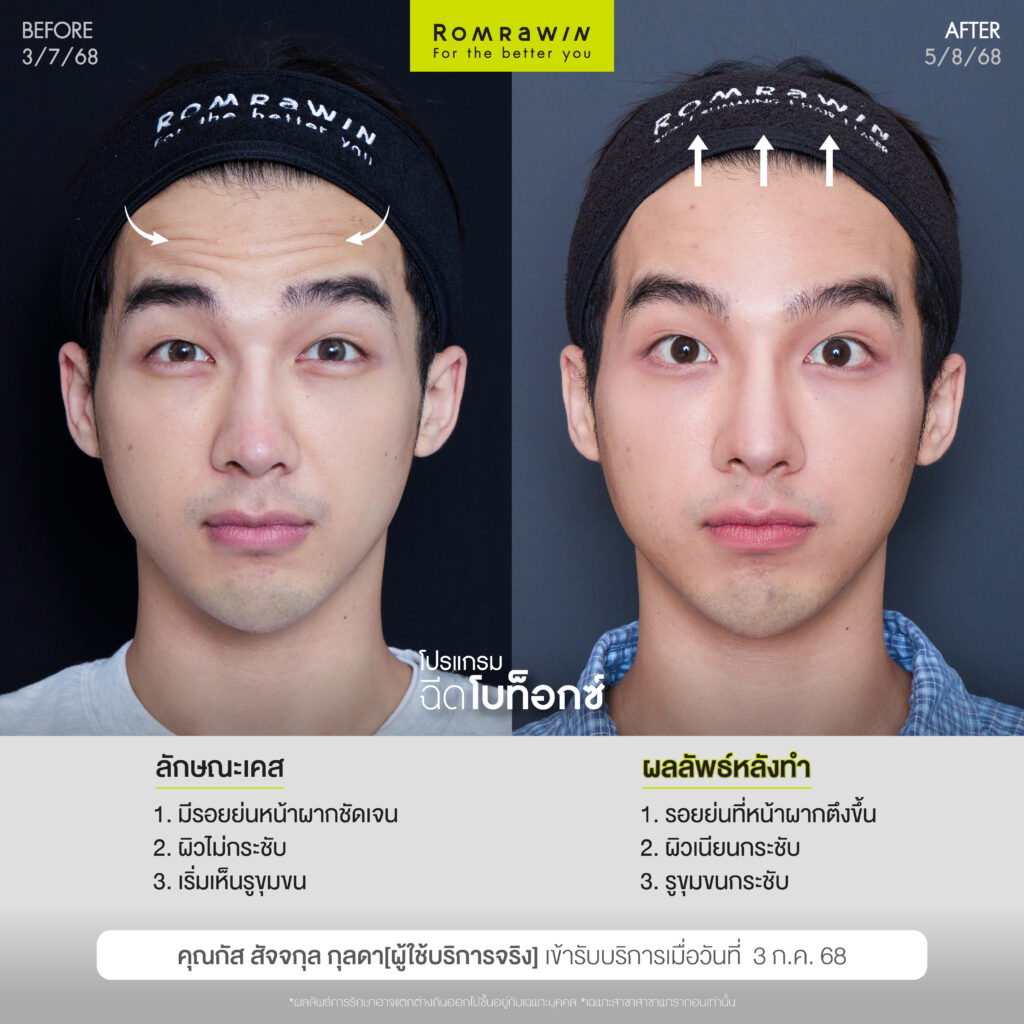 อัปเกรดลุคใหม่ หล่อใสสไตล์อปป้าด้วยโปรแกรมฉีดโบ คุณกัส สัจจกุล