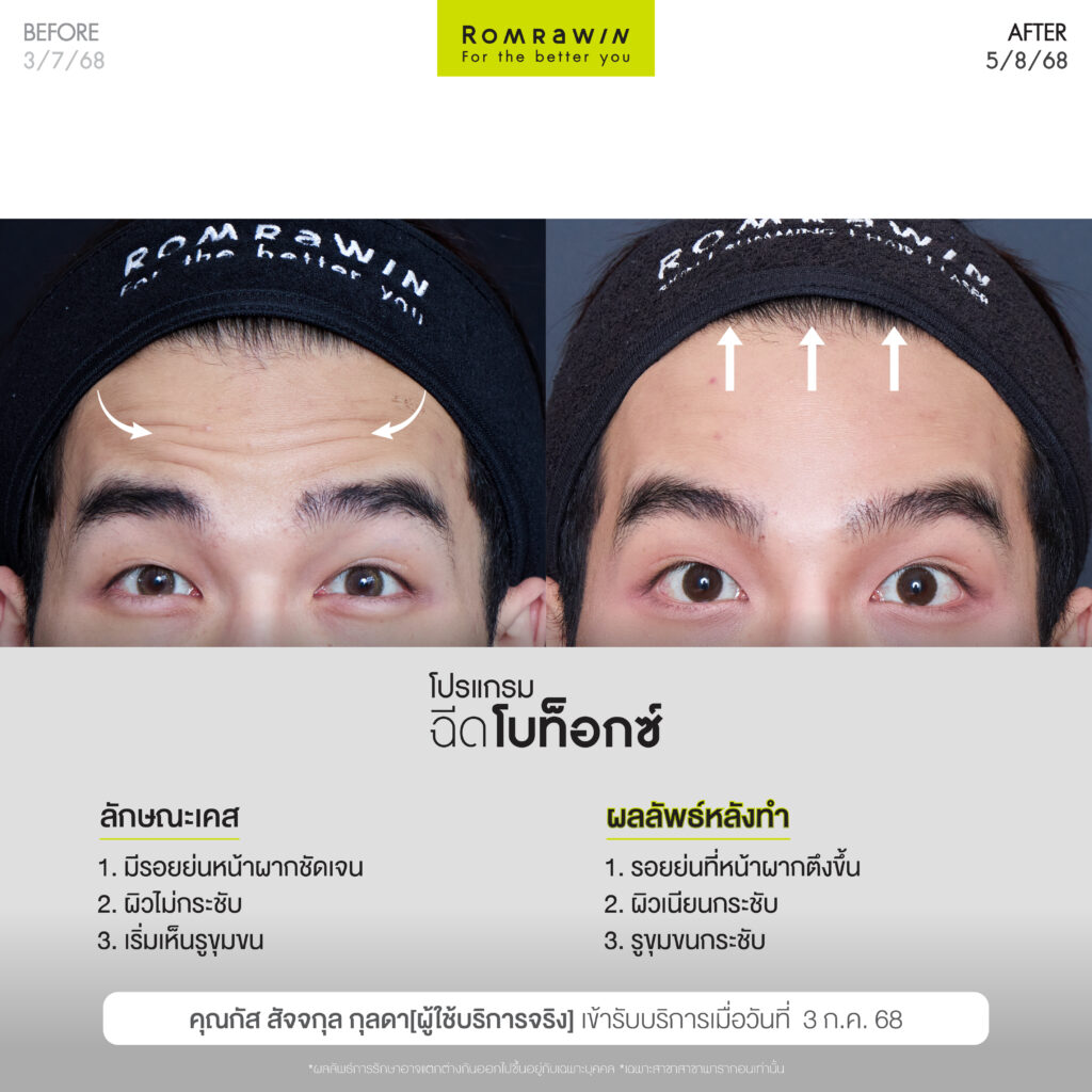 อัปเกรดลุคใหม่ หล่อใสสไตล์อปป้าด้วยโปรแกรมฉีดโบ คุณกัส สัจจกุล