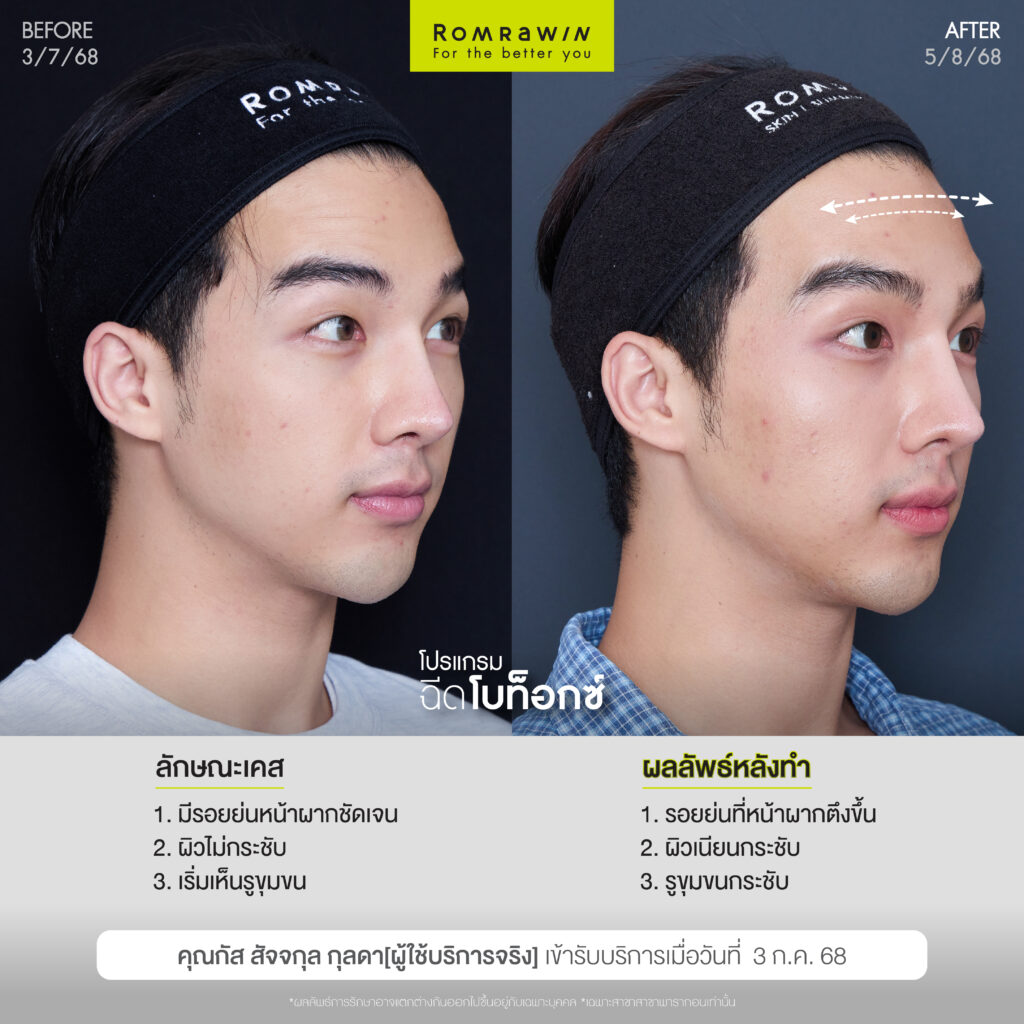 อัปเกรดลุคใหม่ หล่อใสสไตล์อปป้าด้วยโปรแกรมฉีดโบ คุณกัส สัจจกุล