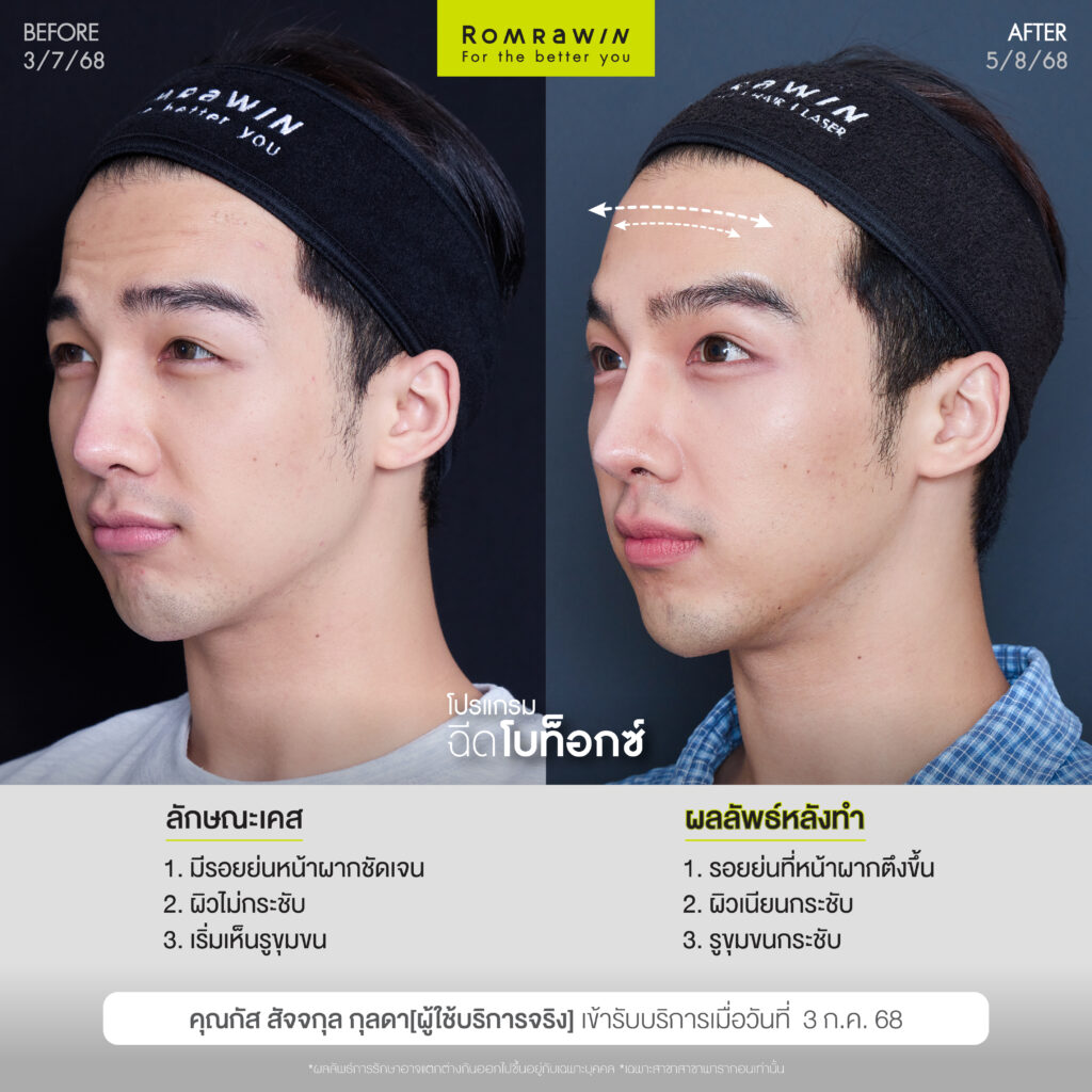 อัปเกรดลุคใหม่ หล่อใสสไตล์อปป้าด้วยโปรแกรมฉีดโบ คุณกัส สัจจกุล