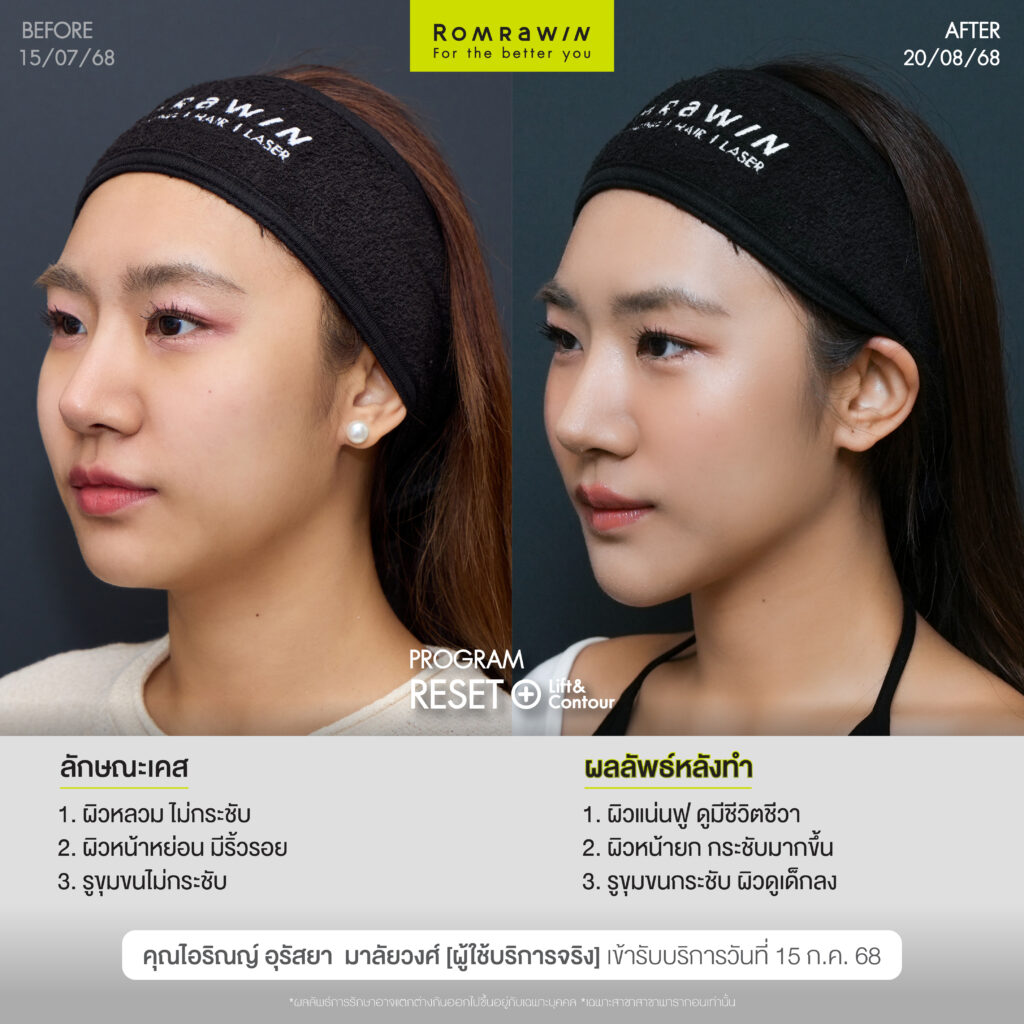 คุณไอริณญ์หน้า Young กรอบ LIFT ด้วยโปรแกรม RESET+ Lift & Contour