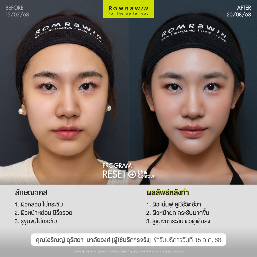 คุณไอริณญ์หน้า Young กรอบ LIFT ด้วยโปรแกรม RESET+ Lift & Contour