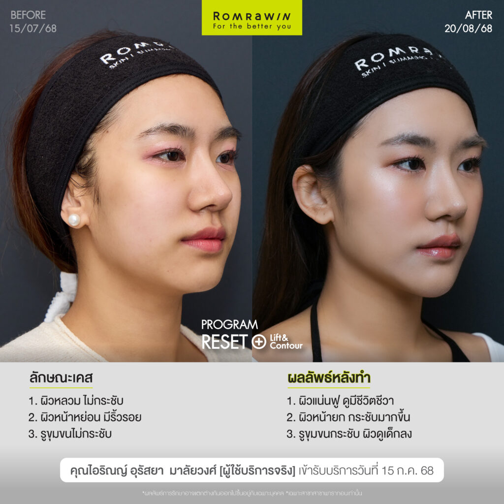 คุณไอริณญ์หน้า Young กรอบ LIFT ด้วยโปรแกรม RESET+ Lift & Contour