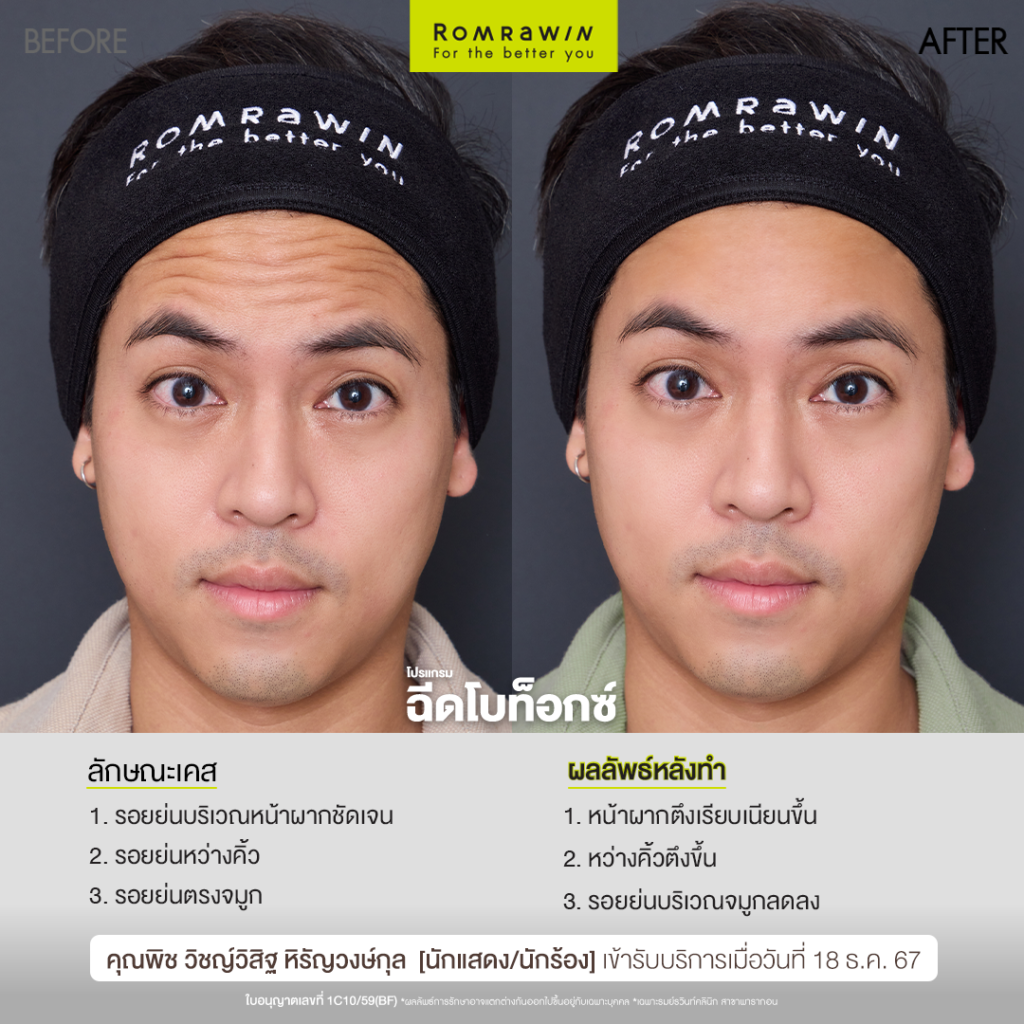 โปรแกรมฉีดโบ ล็อกผิวคุณพิช วิชญ์วิสิฐ ให้ดูอ่อนวัยเหมือนเคย 2 โปรแกรมฉีดโบ ล็อกผิวคุณพิช วิชญ์วิสิฐ ให้ดูอ่อนวัยเหมือนเคย