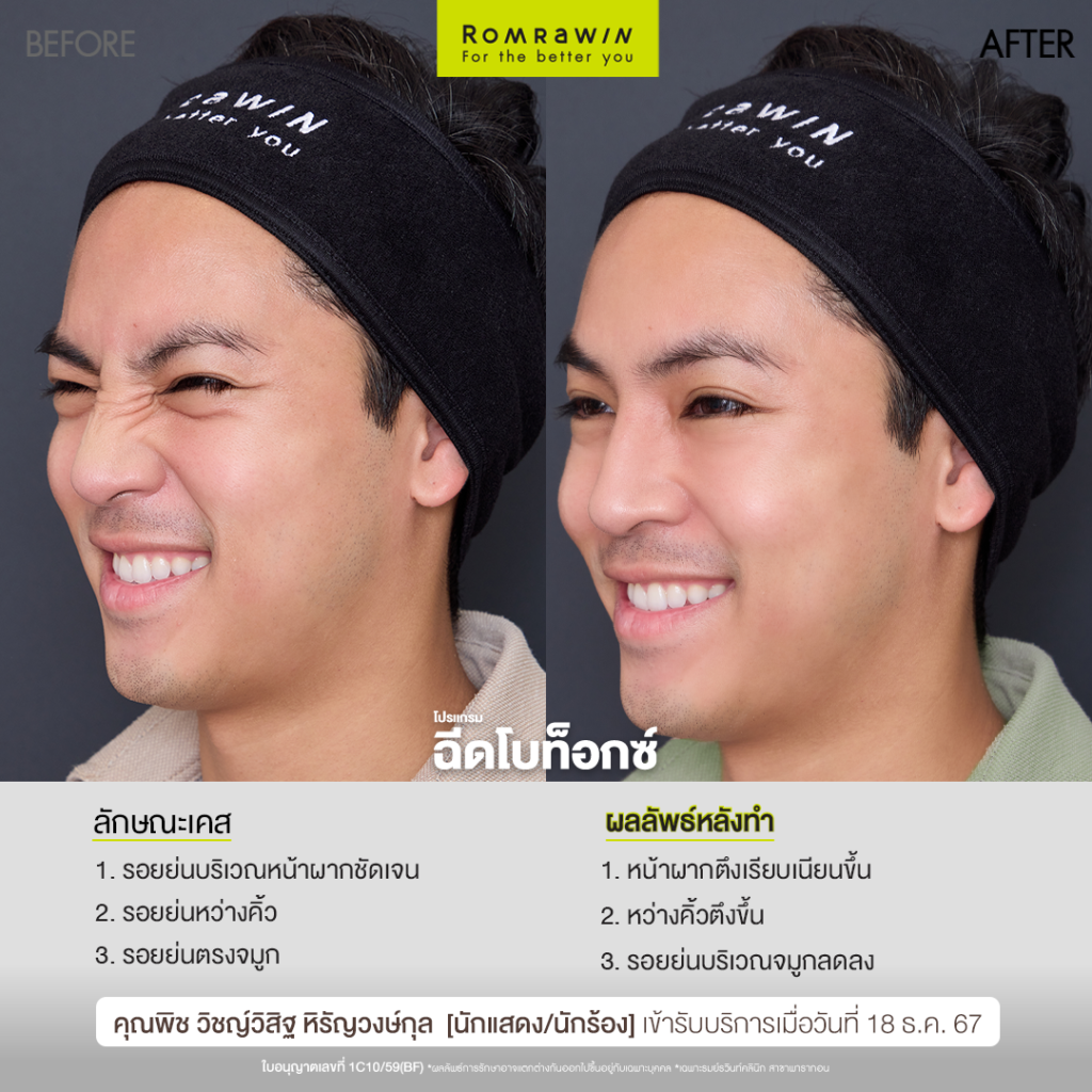 โปรแกรมฉีดโบ ล็อกผิวคุณพิช วิชญ์วิสิฐ ให้ดูอ่อนวัยเหมือนเคย 4 โปรแกรมฉีดโบ ล็อกผิวคุณพิช วิชญ์วิสิฐ ให้ดูอ่อนวัยเหมือนเคย