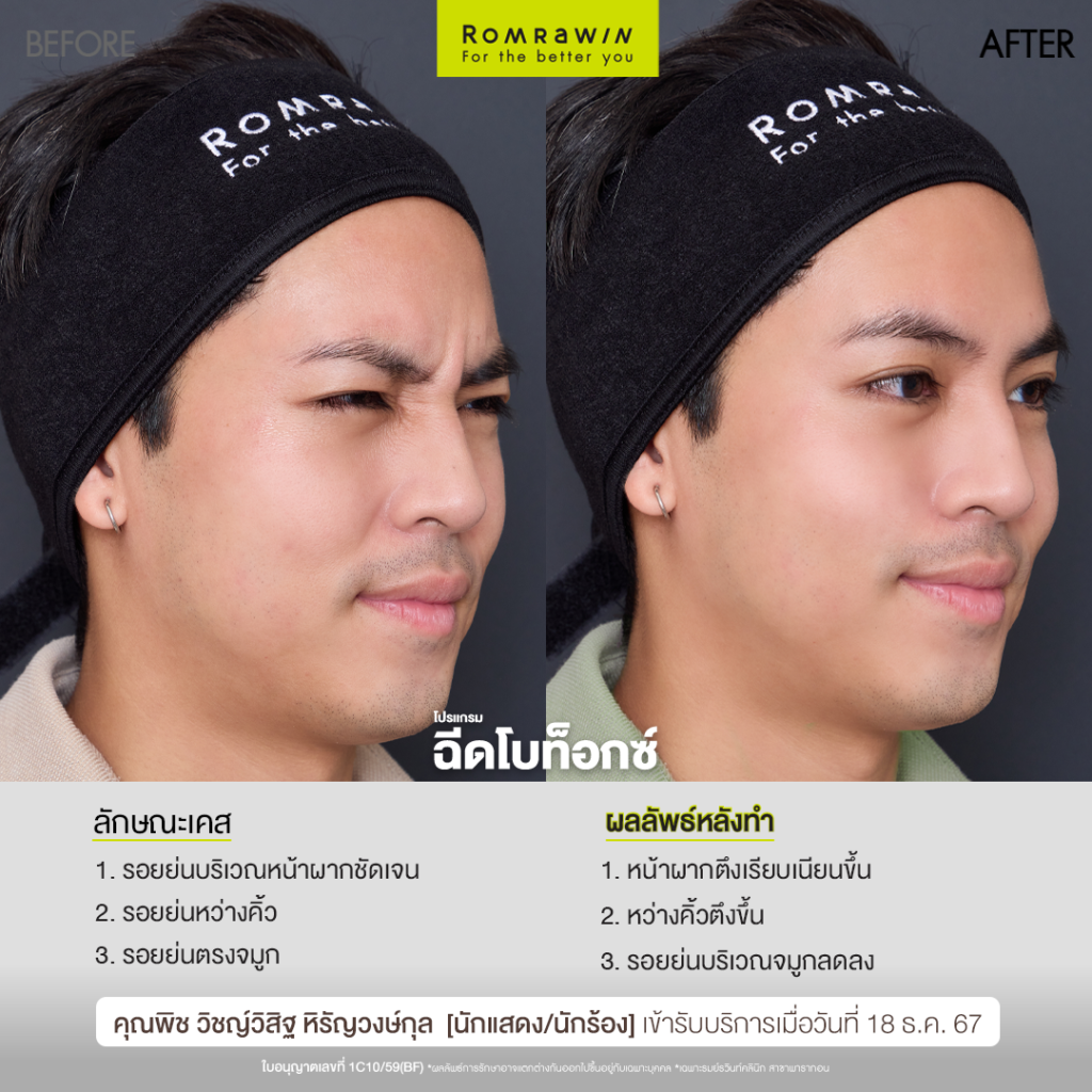 โปรแกรมฉีดโบ ล็อกผิวคุณพิช วิชญ์วิสิฐ ให้ดูอ่อนวัยเหมือนเคย 3 โปรแกรมฉีดโบ ล็อกผิวคุณพิช วิชญ์วิสิฐ ให้ดูอ่อนวัยเหมือนเคย