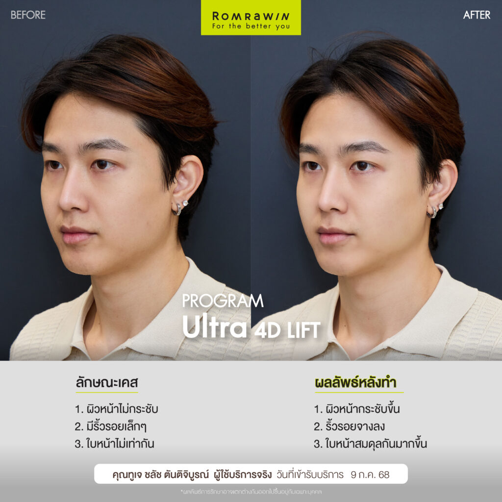 Lift & Renew 2 Combo ดแลผิวหน้าคุณทูเจ ชลัชให้จึ้ง 
