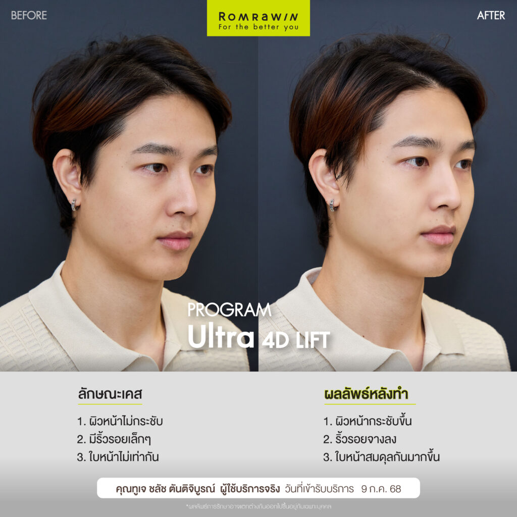 Lift & Renew 2 Combo ดแลผิวหน้าคุณทูเจ ชลัชให้จึ้ง 